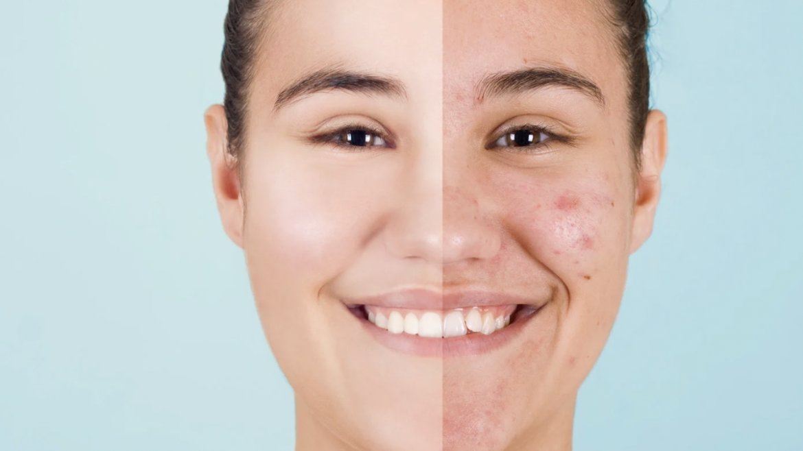 Advanced Acne Treatments and Skin Solutions Near McLean, VA