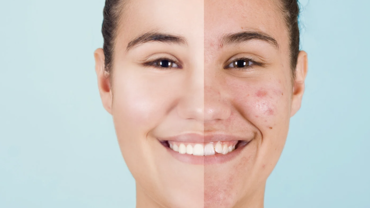 Advanced Acne Treatments and Skin Solutions Near McLean, VA