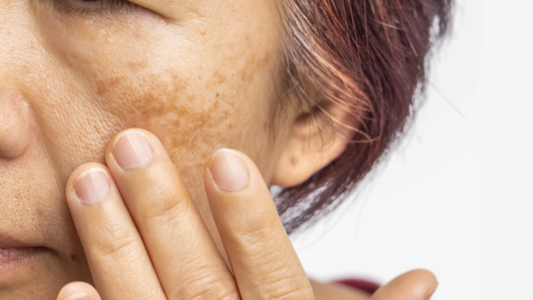 Best Melasma Specialist in Northern Virginia for Advanced Hyperpigmentation Treatments