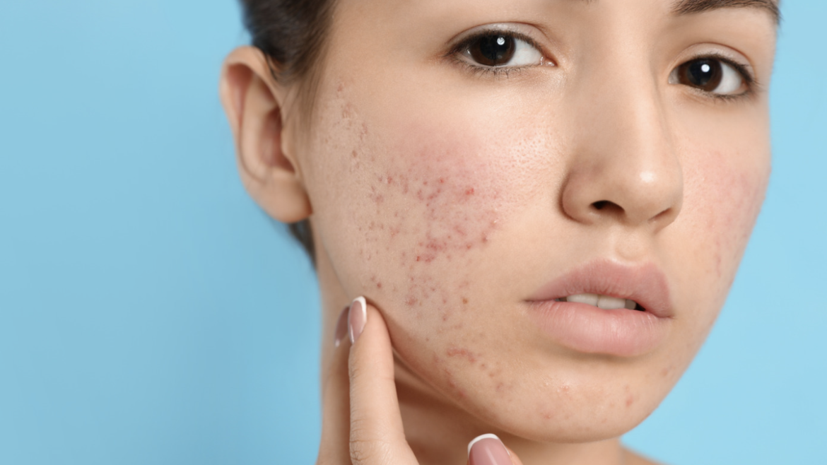 Expert Acne Care and Customized Skin Care Solutions Near McLean, VA