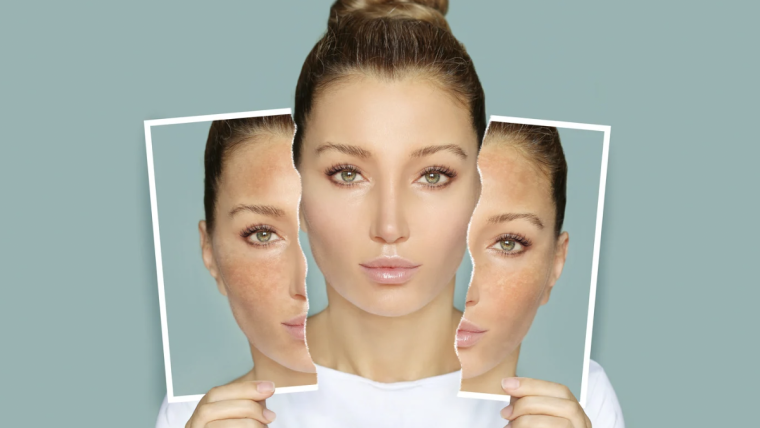 Cutting-Edge Melasma Solutions in Northern Virginia