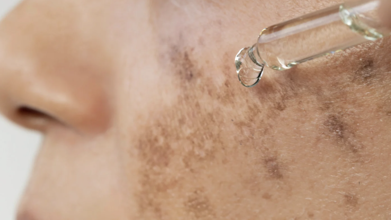 How to Find the Best Melasma Specialist in Northern Virginia