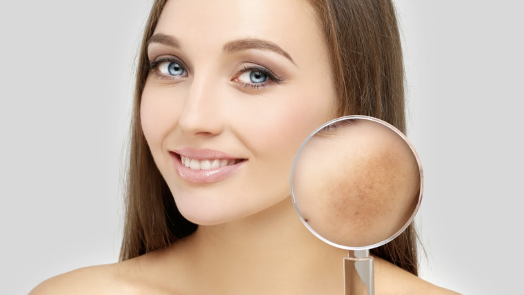 Top-Rated Melasma Treatment Clinic in Northern Virginia