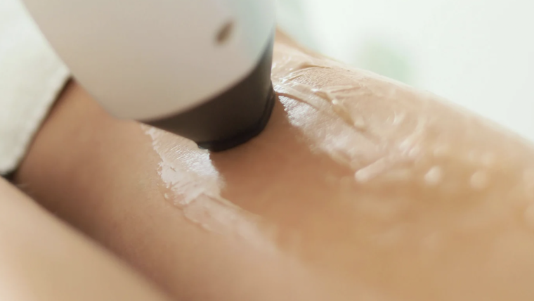 Finding Affordable Laser Hair Removal in Leesburg, Virginia
