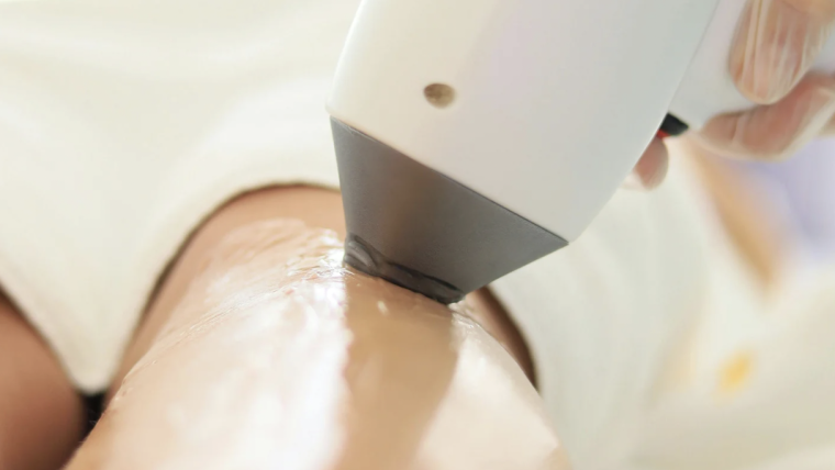 Smooth Skin With Laser Hair Removal in Arlington, Virginia