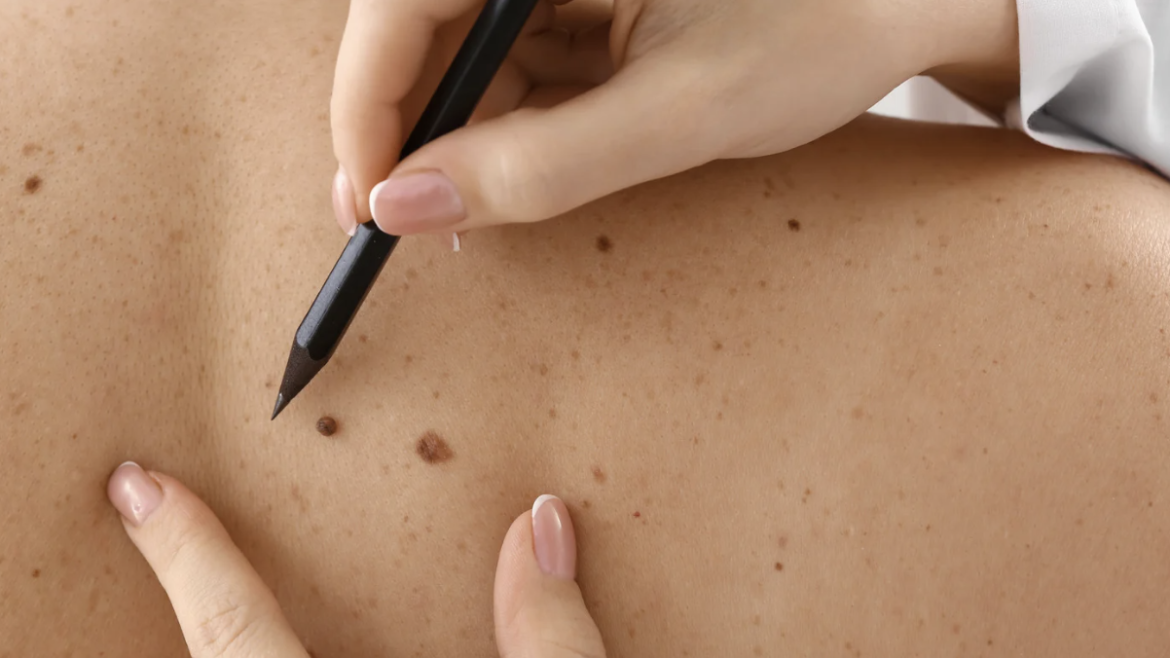 Skin Check and Mole Evaluation Appointment in Arlington, Virginia