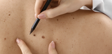 Skin Check and Mole Evaluation Appointment in Arlington, Virginia