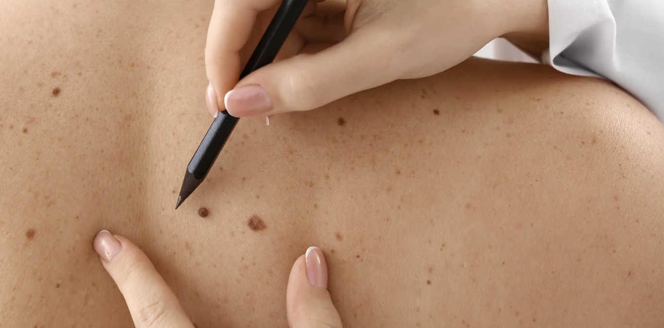 Skin Check and Mole Evaluation Appointment in Arlington, Virginia Skin Check and Mole Evaluation Appointment in Arlington, Virginia