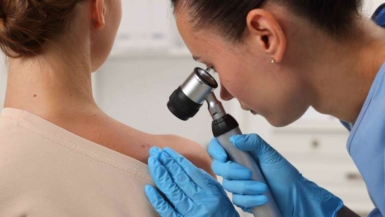 Dermatology Consultation for Mole and Skin Cancer Screening Near McLean, Virginia