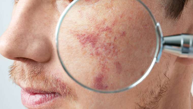 Dermatology Appointment for Hyperpigmentation and Dark Spot Correction Near Tysons, Virginia