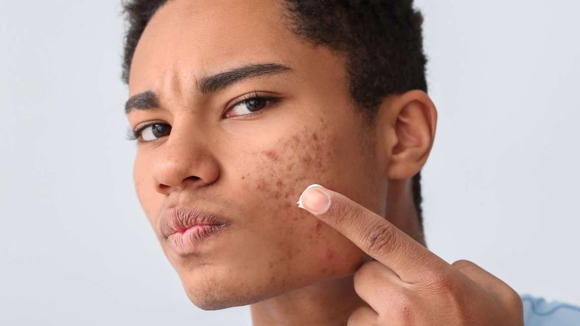 Book a Dermatology Appointment for Sudden Acne Breakouts Near McLean, VA