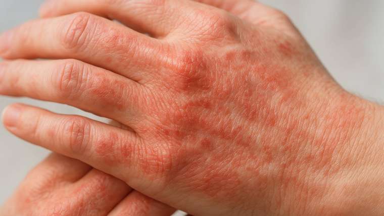 Eczema Flare-Up Treatment Dermatologist Appointment Near McLean, VA