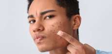 Book a Dermatology Appointment for Sudden Acne Breakouts Near McLean, VA