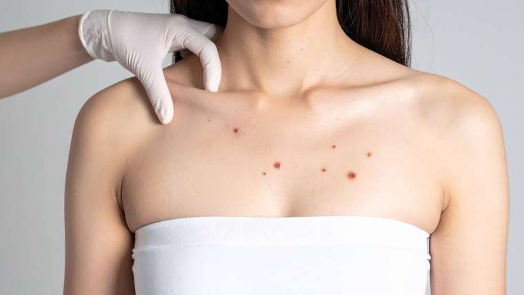 Mole Check/Skin Cancer Screening Availability Near McLean, VA