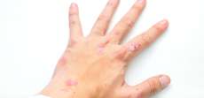 Psoriasis Symptom Evaluation and Treatment Options Near McLean, VA
