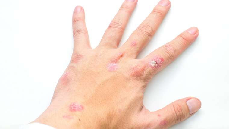 Psoriasis Symptom Evaluation and Treatment Options Near McLean, VA