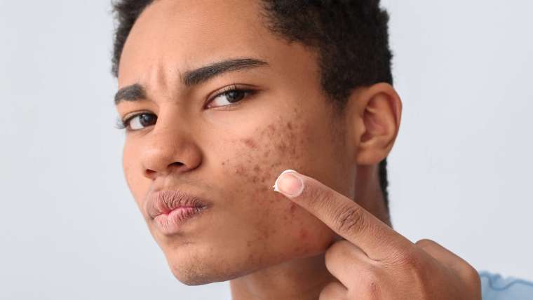 Book a Dermatology Appointment for Sudden Acne Breakouts Near McLean, VA