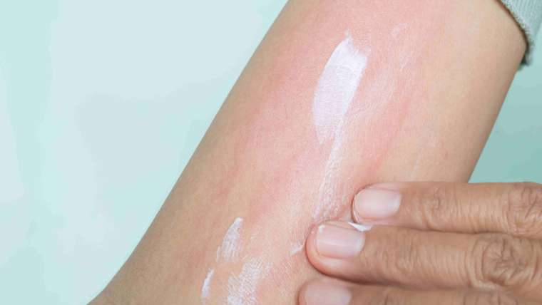 Book A Dermatology Visit for Eczema Flare-Ups Near Fairfax, Virginia