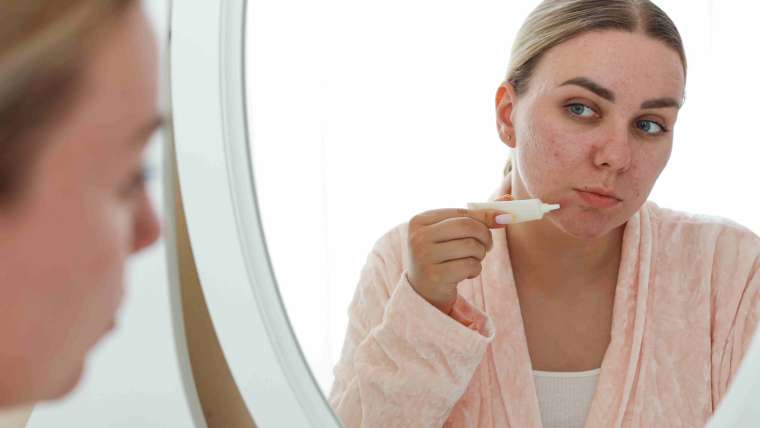 Dermatologist Appointment for Acne Treatment in Arlington, Virginia