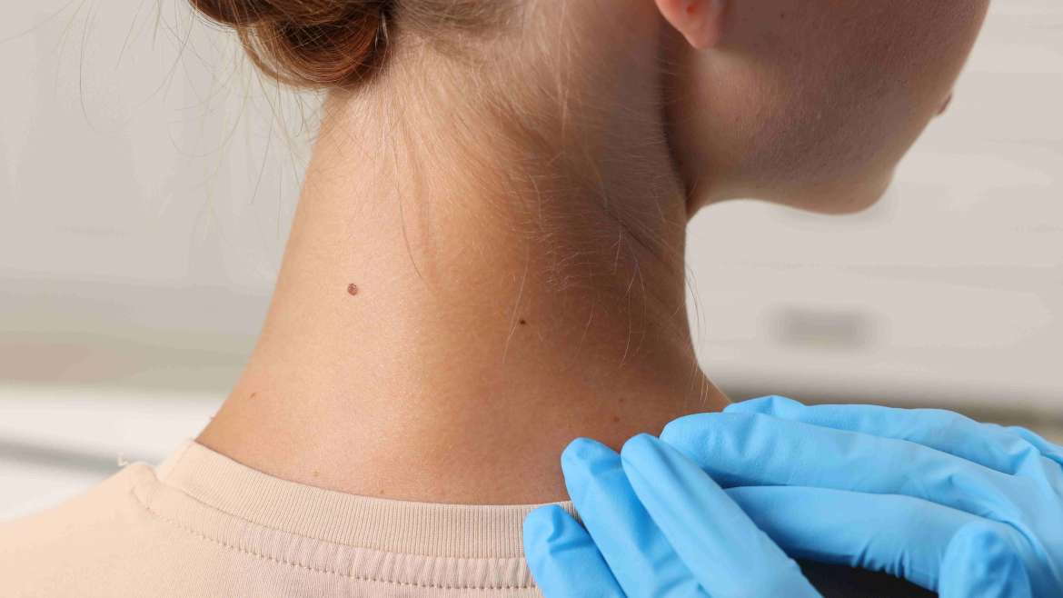 Dermatology Appointment for a Mole Check in Vienna, Virginia