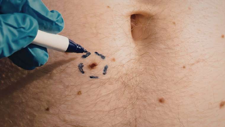 Skin Check Appointment Near Alexandria, Virginia for Mole Evaluation