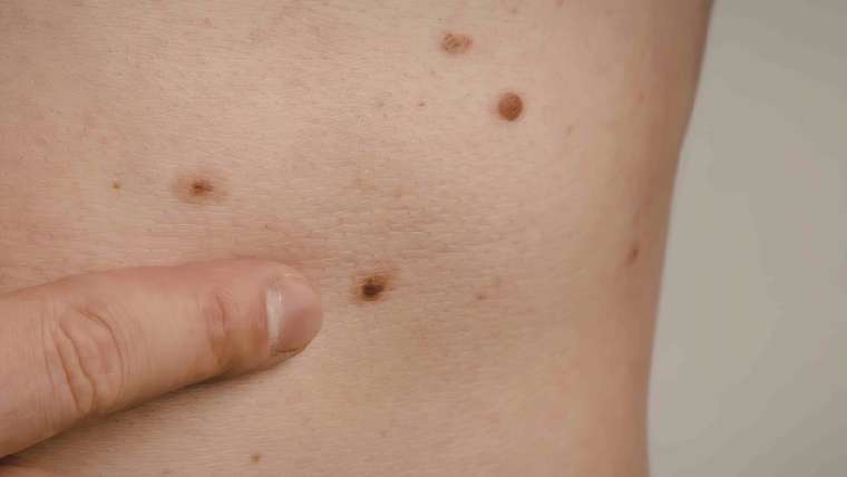 Emergency Mole Check in Tysons Corner, Virginia