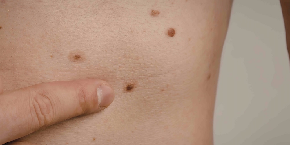 Emergency Mole Check in Tysons Corner, Virginia