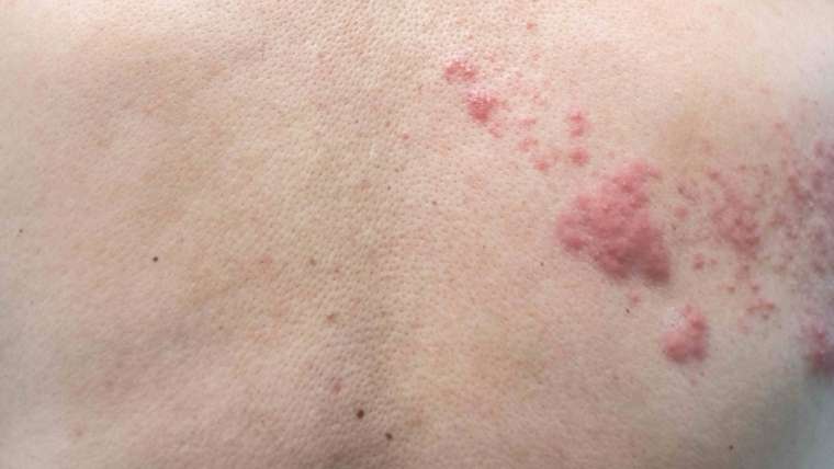 Emergency Treatment for Shingles in Tysons Corner, Virginia