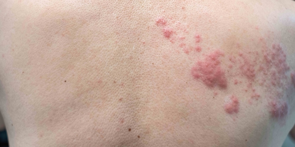 Emergency Treatment for Shingles in Tysons Corner, Virginia