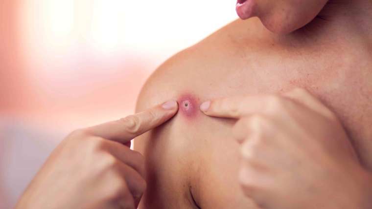 Dermatology In Tysons Corner, Virginia for Painful Cyst or Abscess