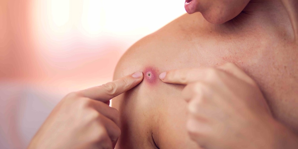 Dermatology In Tysons Corner, Virginia for Painful Cyst or Abscess