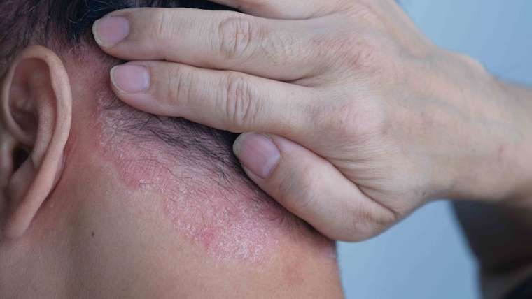 Same Day Psoriasis Treatment Appointment in Vienna, Virginia