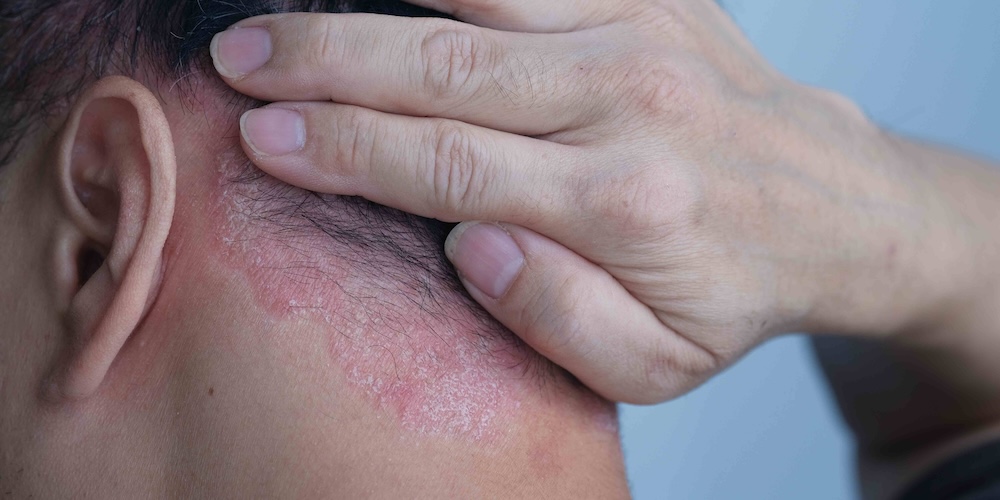 Same Day Psoriasis Treatment Appointment in Vienna, Virginia