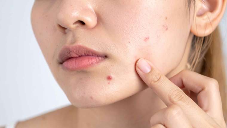 Acne That Won’t Respond to Over-the-Counter Treatment in Vienna, Virginia