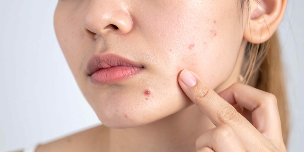 Acne That Won’t Respond to Over-the-Counter Treatment in Vienna, Virginia
