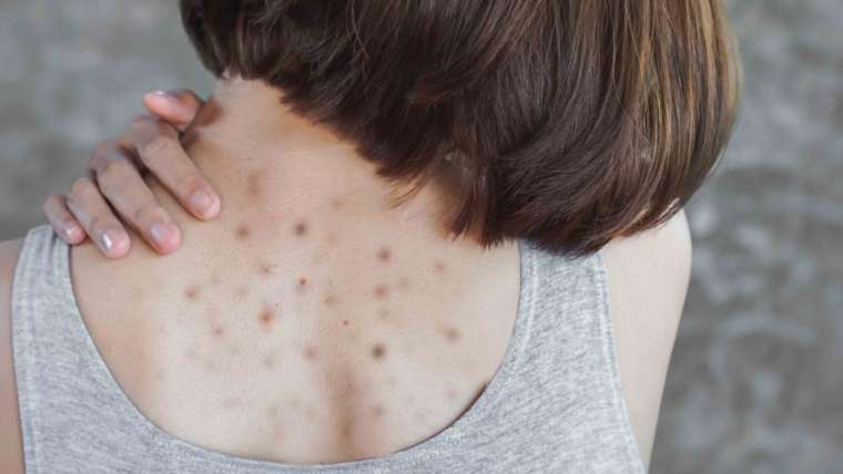 Dermatology Visit for Dark Spots or Uneven Skin Pigmentation in McLean, Virginia