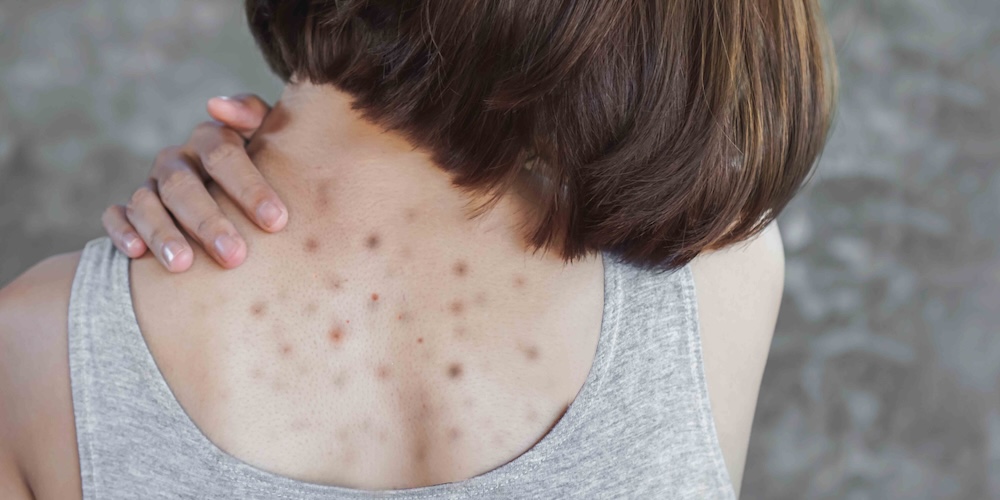 Dermatology Visit for Dark Spots or Uneven Skin Pigmentation in McLean, Virginia