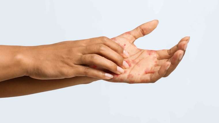 Same-Day Appointment for Severe Eczema Flare in Vienna, Virginia