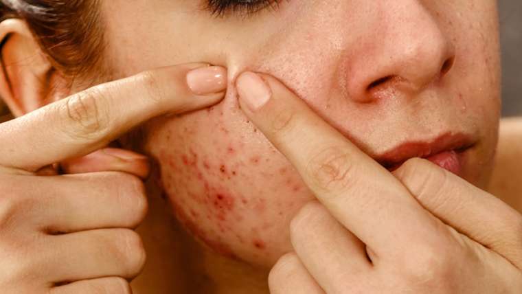 Best Dermatologist Appointment for Adult Acne Breakouts in Falls Church, Virginia