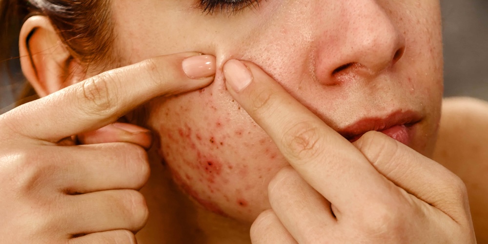 Best Dermatologist Appointment for Adult Acne Breakouts in Falls Church, Virginia