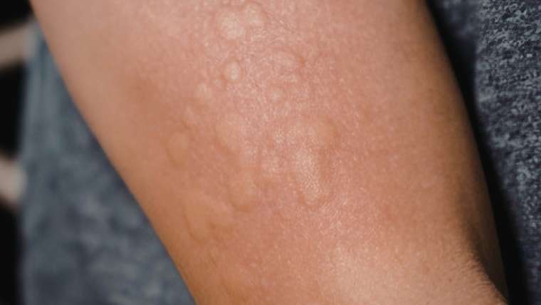 Dermatologist Appointment for Painful Skin Lesions or Bumps in Falls Church, Virginia