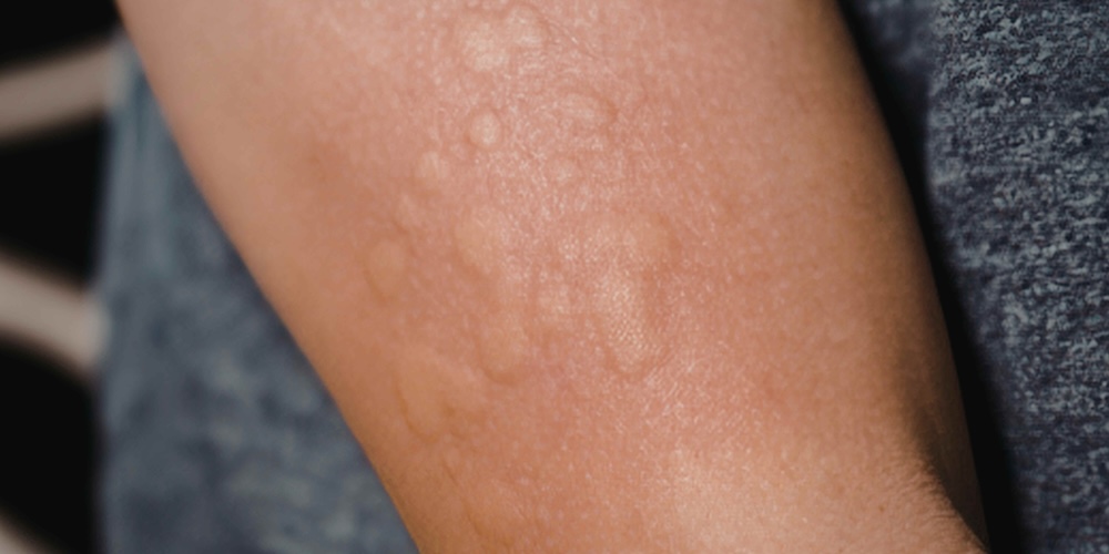 Dermatologist Appointment for Painful Skin Lesions or Bumps in Falls Church, Virginia