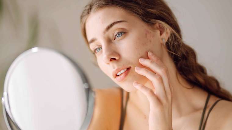 Dermatologist for Persistent Adult Acne Scarring in Falls Church, Virginia