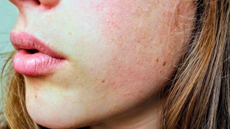Dermatologist for Persistent Facial Redness or Rosacea in Falls Church, Virginia