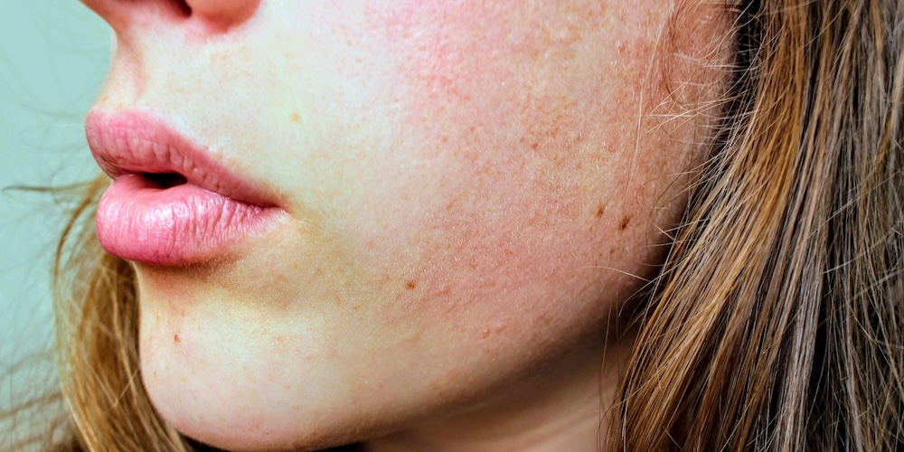 Dermatologist for Persistent Facial Redness or Rosacea in Falls Church, Virginia