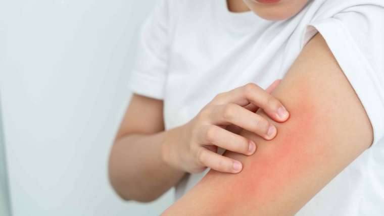 Dermatologist Near McLean, Virginia for Sudden Skin Allergic Reaction or Hives