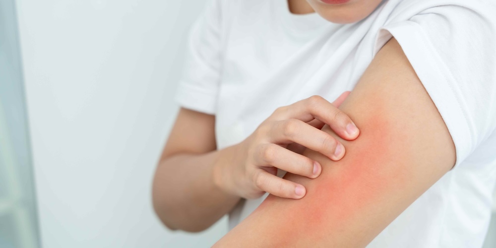 Dermatologist Near McLean, Virginia for Sudden Skin Allergic Reaction or Hives