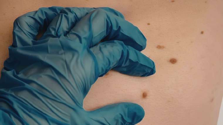 Dermatologist Near McLean, Virginia for a Mole That Changed Shape or Color