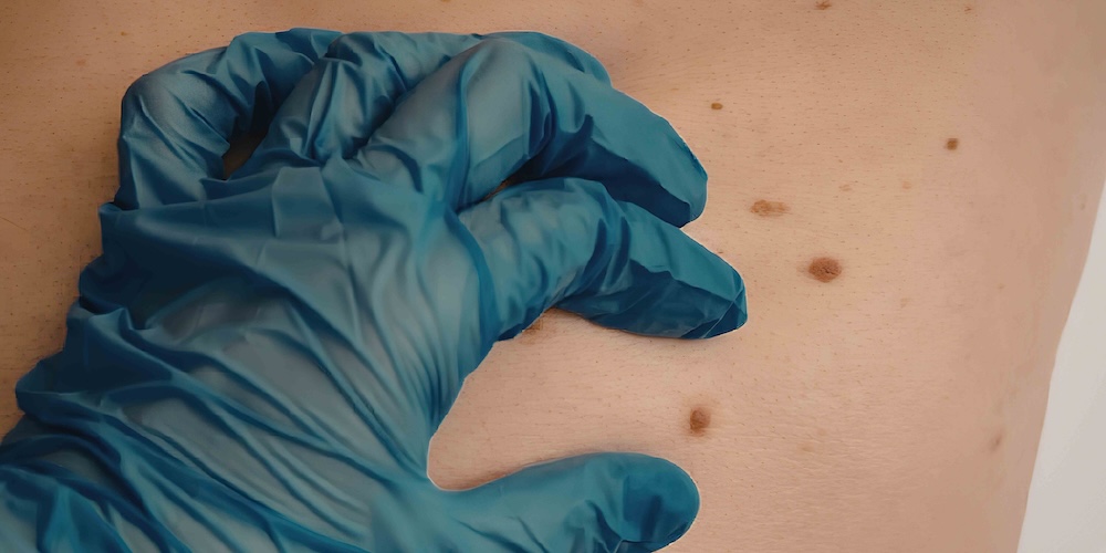 Dermatologist Near McLean, Virginia for a Mole That Changed Shape or Color