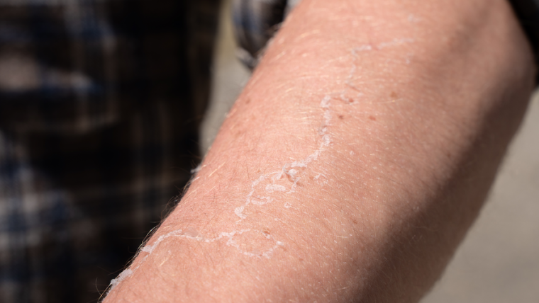 Dermatology Appointment for Dry, Flaky Skin and Possible Psoriasis in Vienna, Virginia